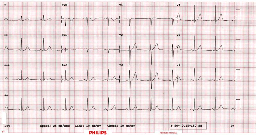   A normal ECG trace